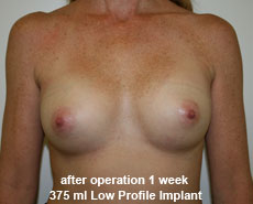 plastic-surgery-breast-augmentation