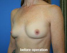plastic-surgery-breast-augmentation
