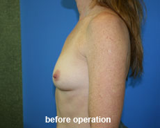 plastic-surgery-breast-augmentation