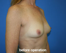 plastic-surgery-breast-augmentation