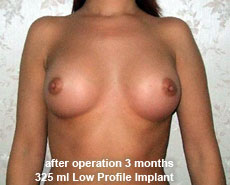 plastic-surgery-breast-augmentation