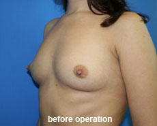 plastic-surgery-breast-augmentation