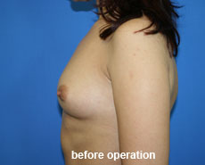 plastic-surgery-breast-augmentation