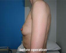 plastic-surgery-breast-augmentation