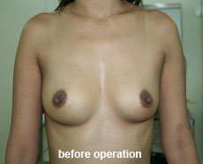 plastic-surgery-breast-augmentation