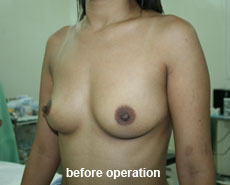 plastic-surgery-breast-augmentation