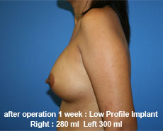plastic-surgery-breast-augmentation