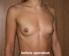plastic-surgery-breast-augmentation