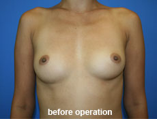 plastic-surgery-breast-augmentation