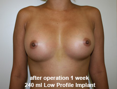 plastic-surgery-breast-augmentation