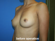 plastic-surgery-breast-augmentation