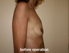 plastic-surgery-breast-augmentation