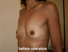 plastic-surgery-breast-augmentation