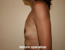 plastic-surgery-breast-augmentation