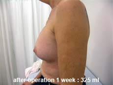 plastic-surgery-breast-augmentation 