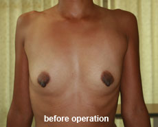 plastic-surgery-breast-augmentation