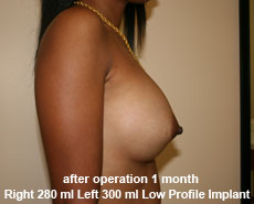 plastic-surgery-breast-augmentation