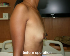 plastic-surgery-breast-augmentation