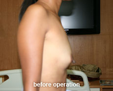 plastic-surgery-breast-augmentation