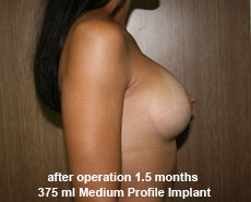 plastic-surgery-breast-augmentation