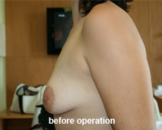 plastic-surgery-breast-augmentation