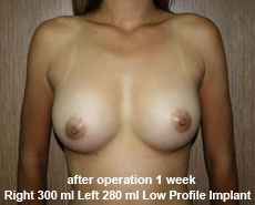 plastic-surgery-breast-augmentation