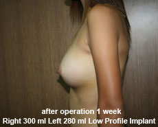 plastic-surgery-breast-augmentation