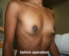 plastic-surgery-breast-augmentation