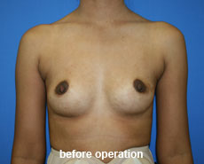 plastic-surgery-breast-augmentation