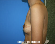 plastic-surgery-breast-augmentation