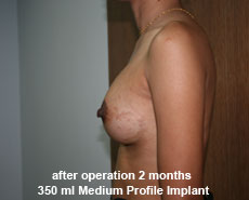 plastic-surgery-breast-augmentation