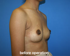 plastic-surgery-breast-augmentation