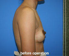 plastic-surgery-breast-augmentation