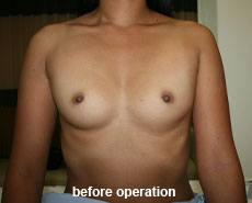 plastic-surgery-breast-augmentation