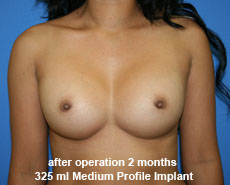 plastic-surgery-breast-augmentation