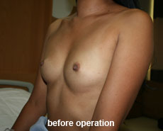 plastic-surgery-breast-augmentation