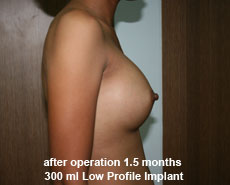 plastic-surgery-breast-augmentation