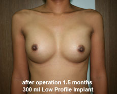 plastic-surgery-breast-augmentation