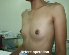 plastic-surgery-breast-augmentation