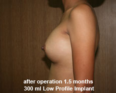 plastic-surgery-breast-augmentation