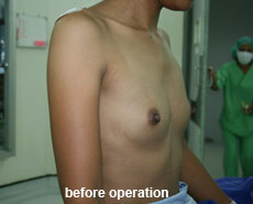 plastic-surgery-breast-augmentation