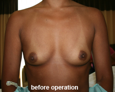 plastic-surgery-breast-augmentation