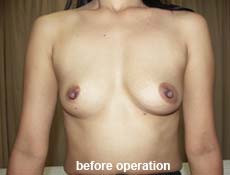 plastic-surgery-breast-augmentation 