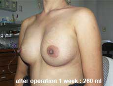 plastic-surgery-breast-augmentation 