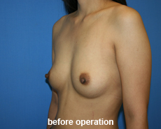 plastic-surgery-breast-augmentation