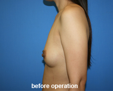 plastic-surgery-breast-augmentation