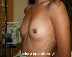 plastic-surgery-breast-augmentation