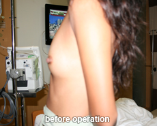 plastic-surgery-breast-augmentation