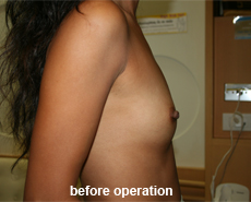 plastic-surgery-breast-augmentation