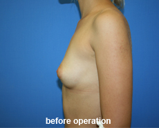 plastic-surgery-breast-augmentation